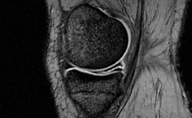 rotura cuerno posterior menisco interno
