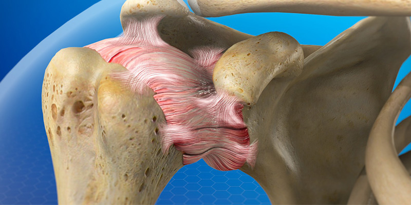 Lesión del hombro congelado (o de hombro rígido)